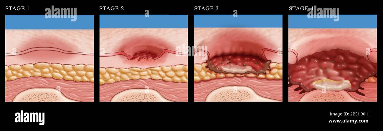 Stage 3 Pressure Sore Pictures