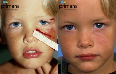 Stitches Face Scar