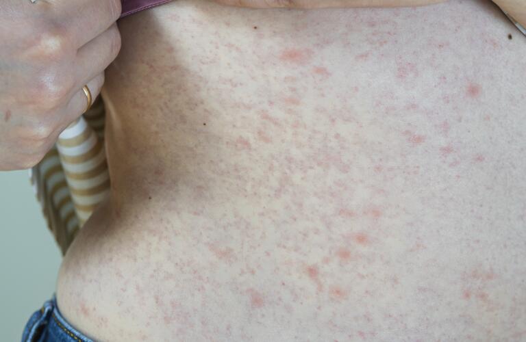 Stomach Rash Guide: Symptoms And Treatments
