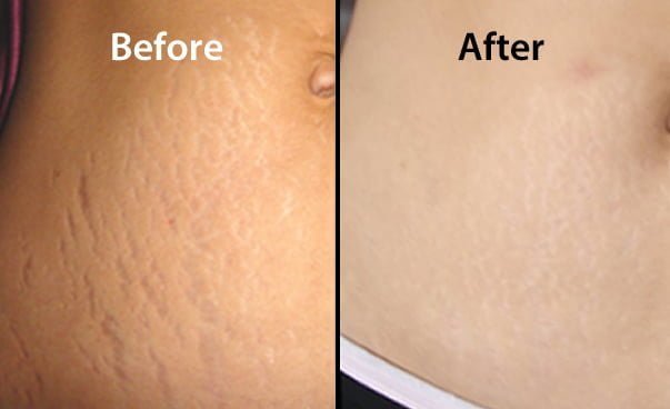 Stretch Marks Removal Laser