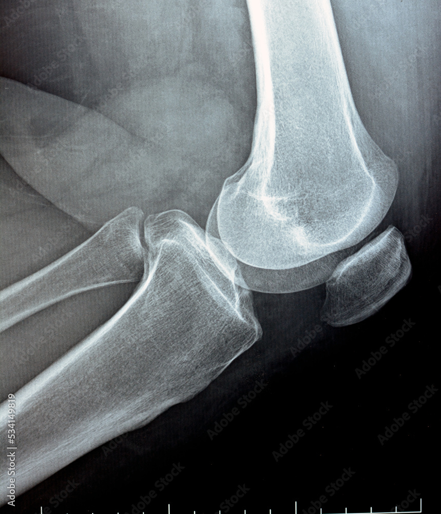 Subchondral Sclerosis Si Joint