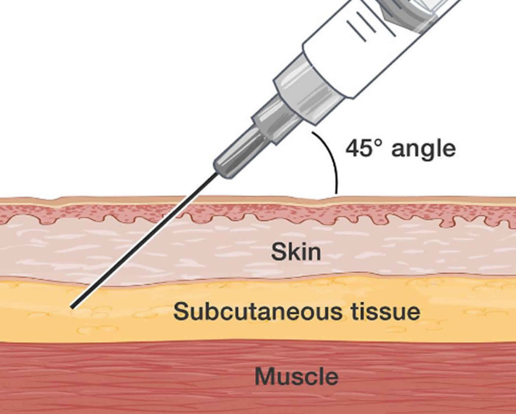 Subcutaneous Injection: Fix Air Bubble Issues