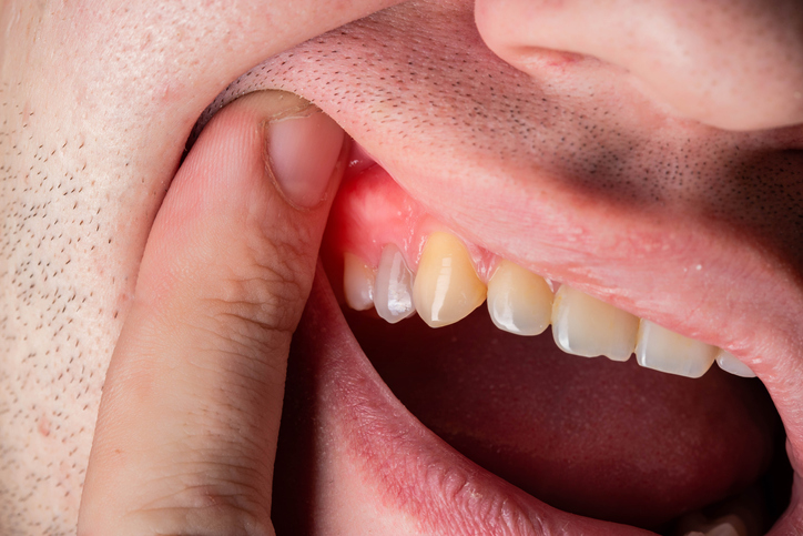 Swollen Gum In One Spot