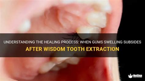 Swollen Gums After Extraction Swollen Gums After Extraction