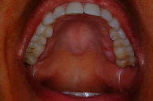 Swollen On Roof Of Mouth