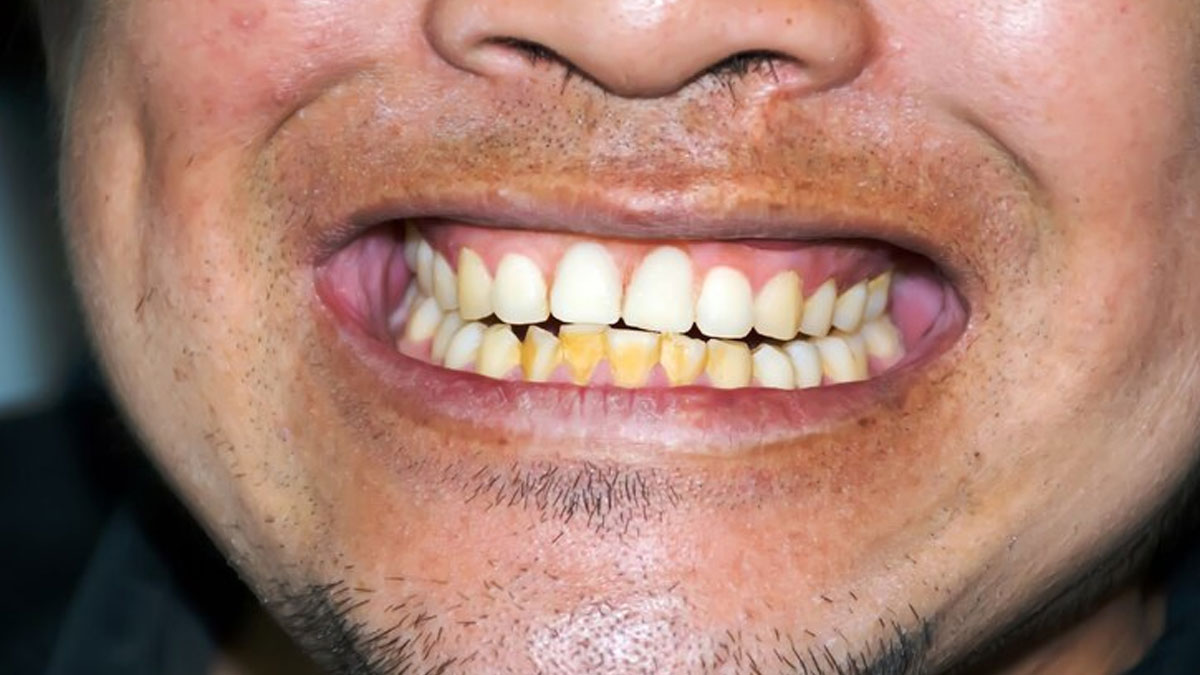 Tartar Vs Teeth Stains What S The Difference Onlymyhealth Tartar Vs Teeth Stains What S The Difference Onlymyhealth