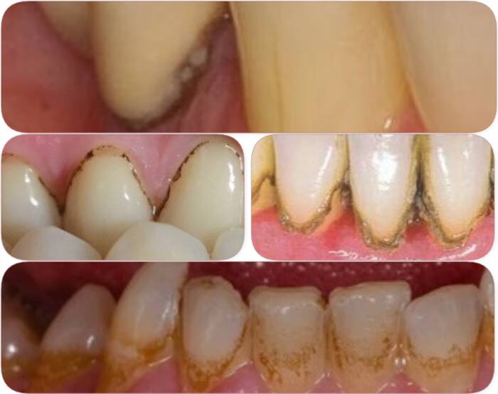 Teeth Black Gums Teeth Black Gums