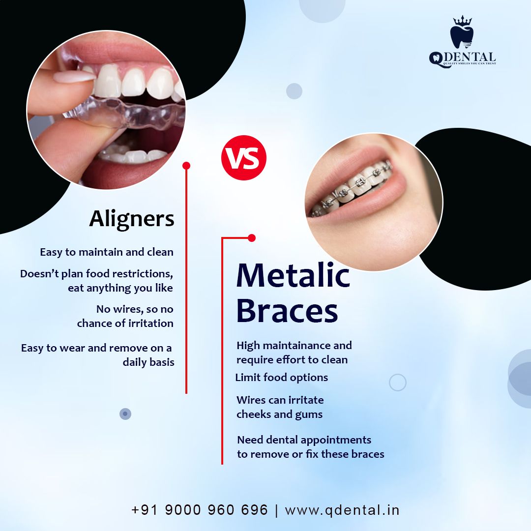 Teeth Braces Colors: Boost Smile Confidence