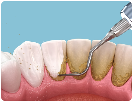 Teeth Cleaning Services
