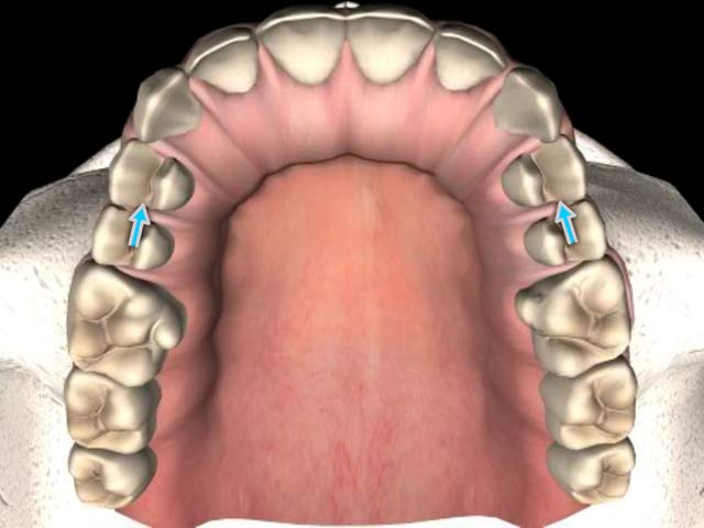 Teeth Imprint Tongue