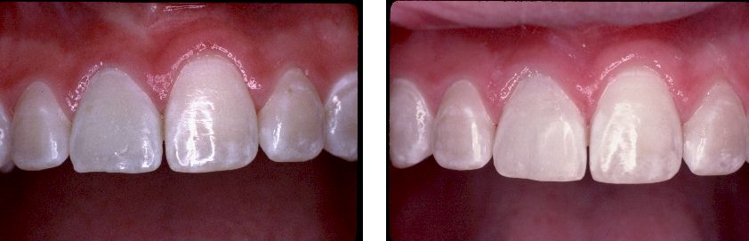 Teeth See Through