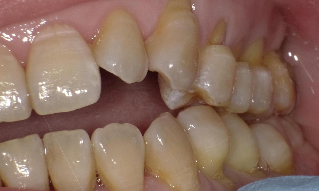 Teeth Sensitive Before Period
