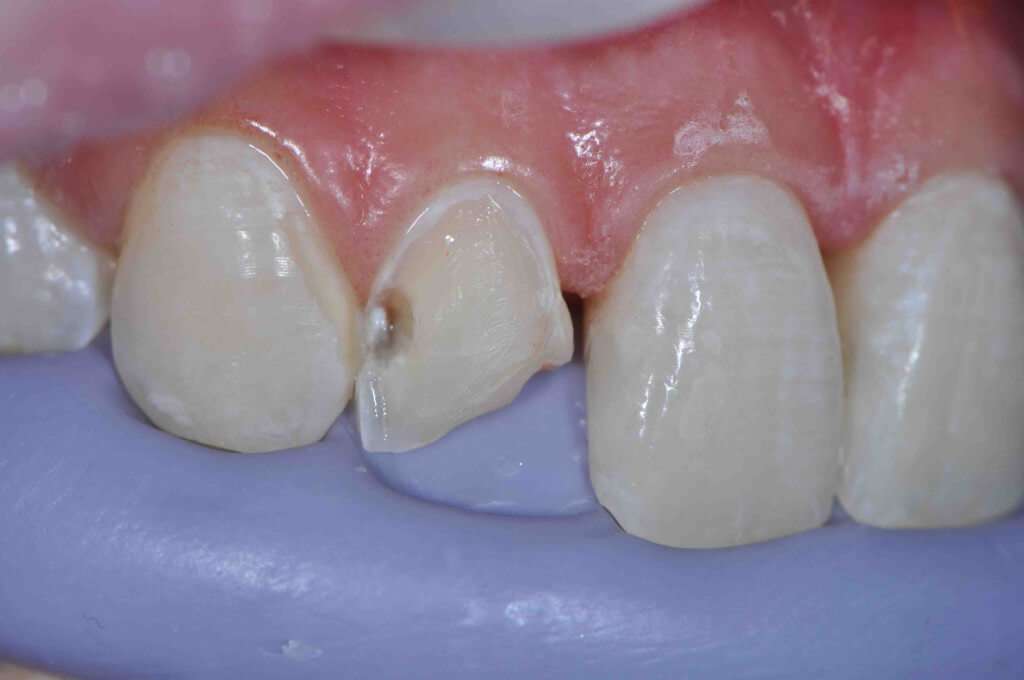 Teeth Translucency Guide: Restore Natural Shine