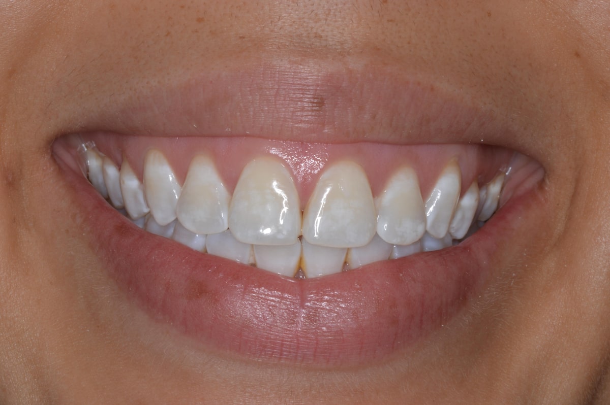 Teeth White Spots Causes Explained