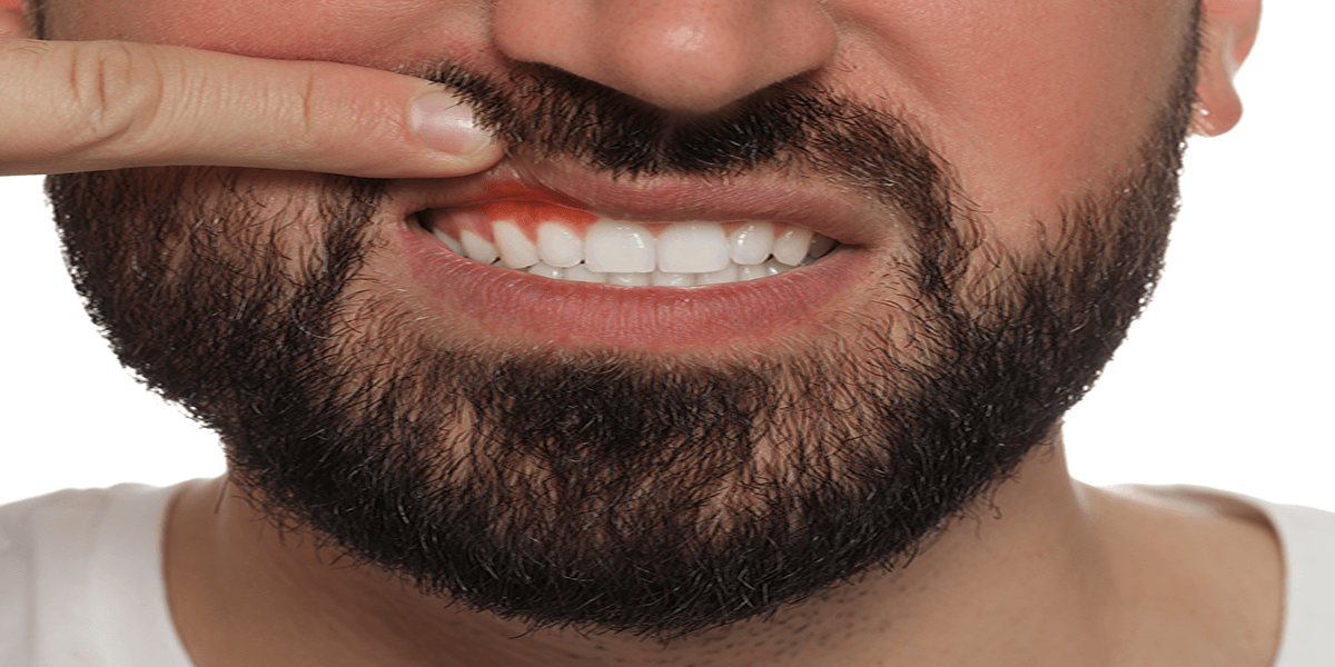 Teeth Whitening Gum Burn