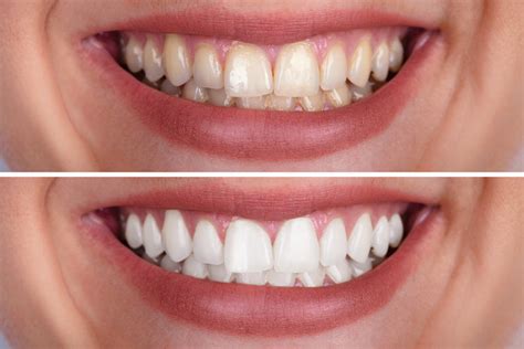 Teeth Whitening Trays Custom: Brighter Teeth Guaranteed