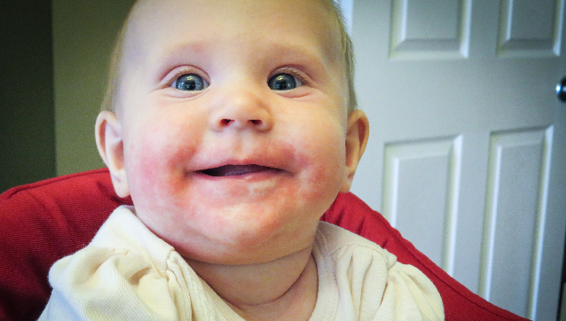 Teething Rash On Cheeks