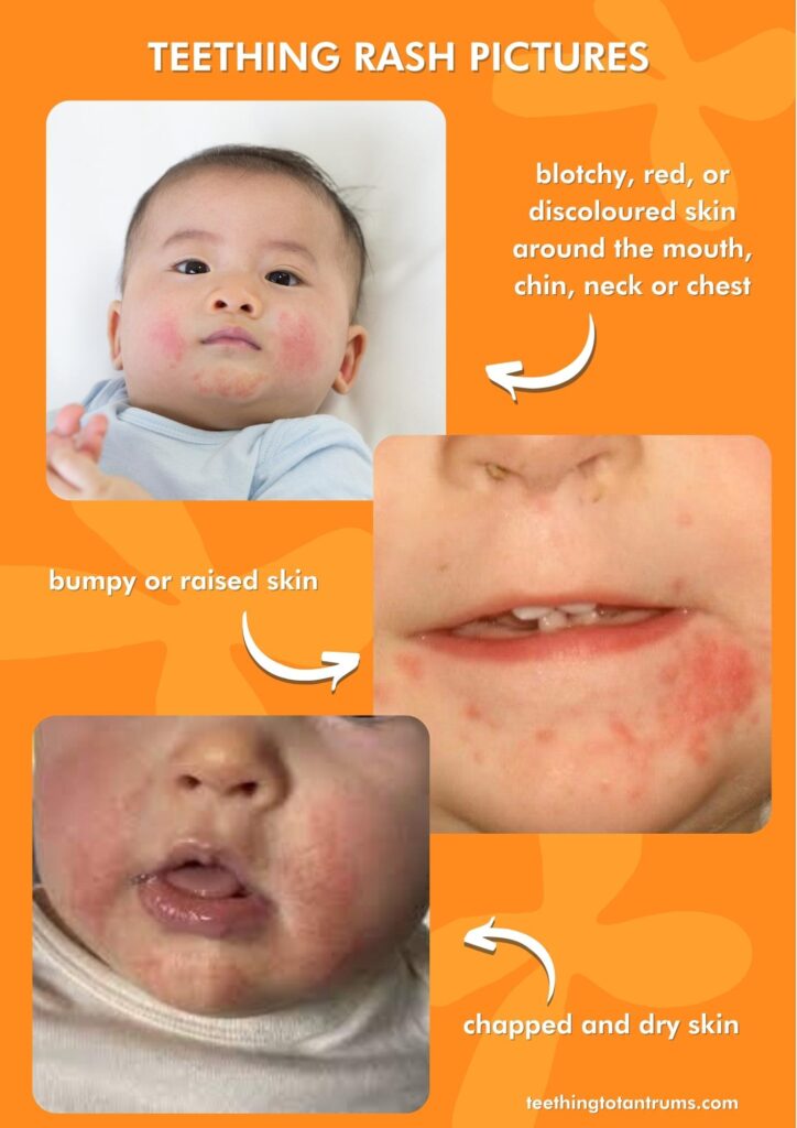 Teething Relief: Soothe Rash On Cheeks