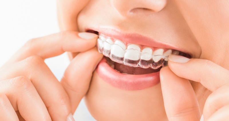 Temporary Retainers For Teeth