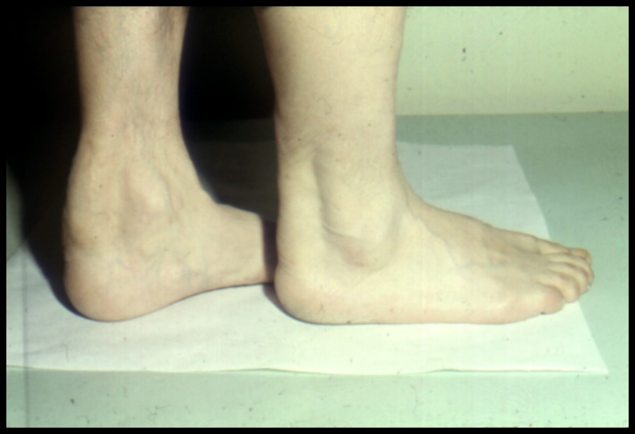 Tendon Xanthomas Images Tendon Xanthomas Images