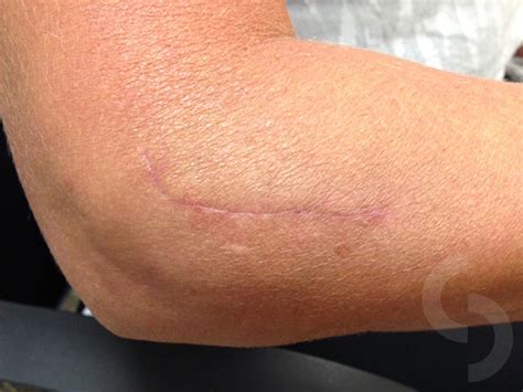 Tennis Elbow Surgery Scar