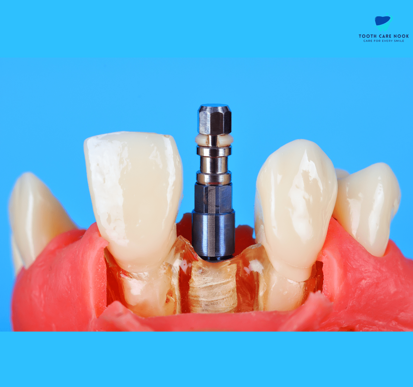 Titanium Implant Tooth