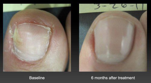 Toenail Fungus Vinegar Before And After Nail Treatment Progression