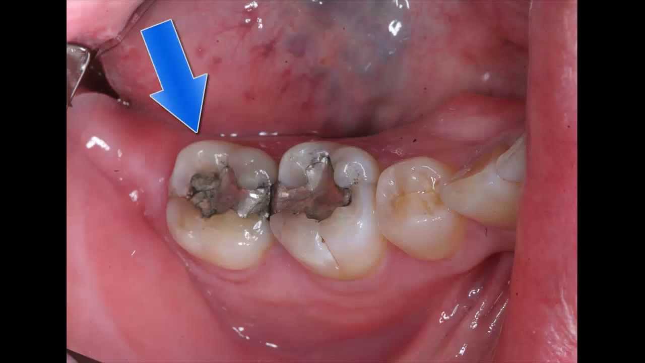Tooth Broke But No Pain Tooth Broke But No Pain