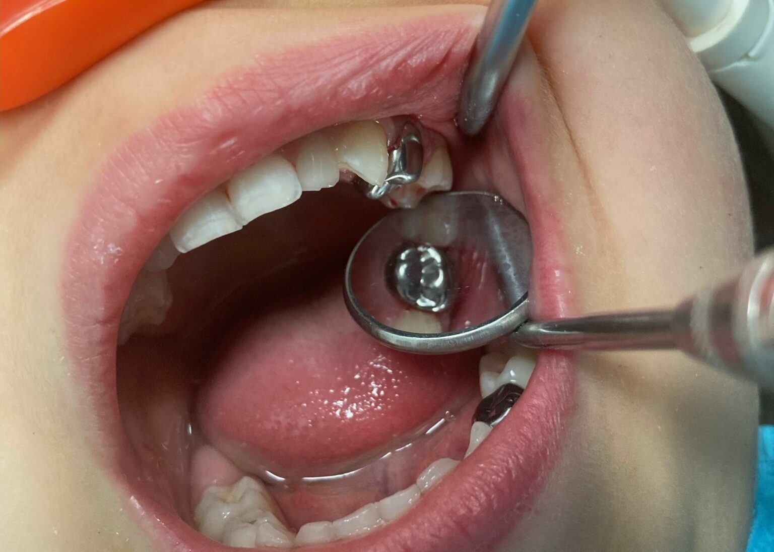 Tooth Crown Sensitive
