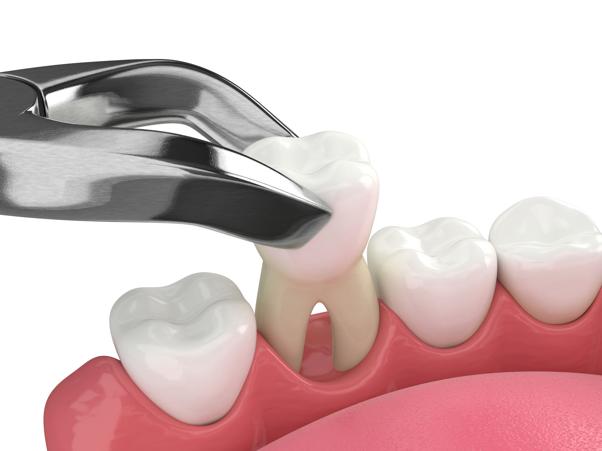 Tooth Extraction Aftercare Tips