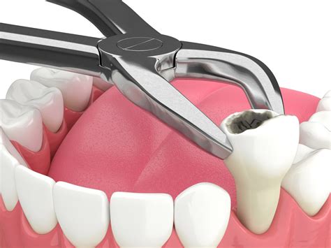 Tooth Extraction Help: Affordable Options