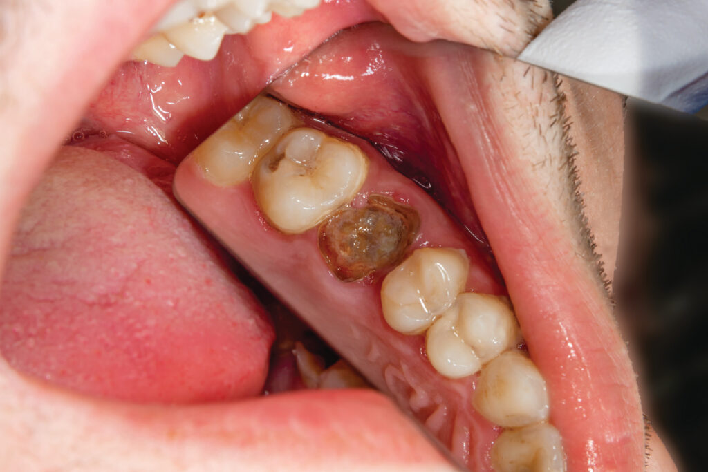 Tooth Infection Removal Guide