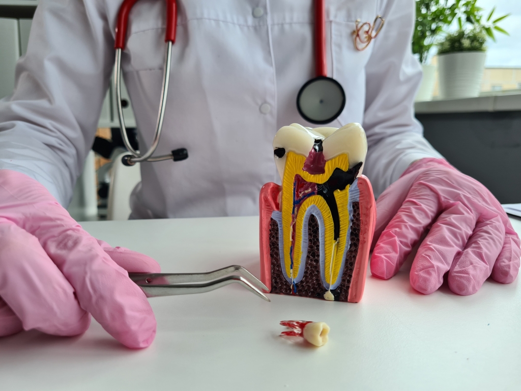 Tooth Nerve Extraction
