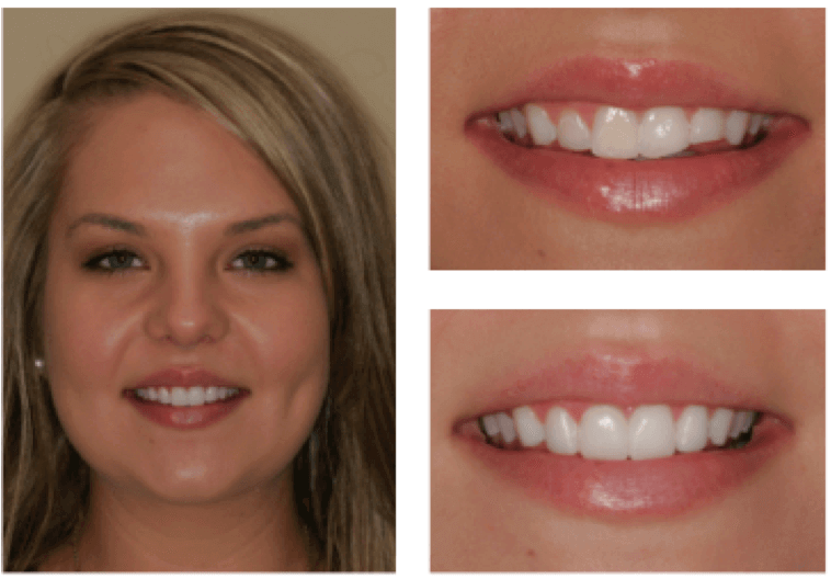 Tooth Porcelain Veneers: Smile Transformation