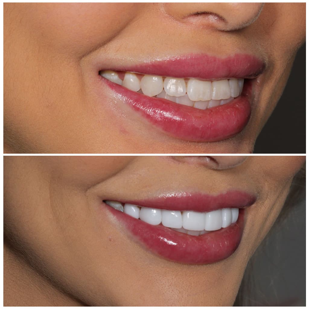 Tooth Porcelain Veneers