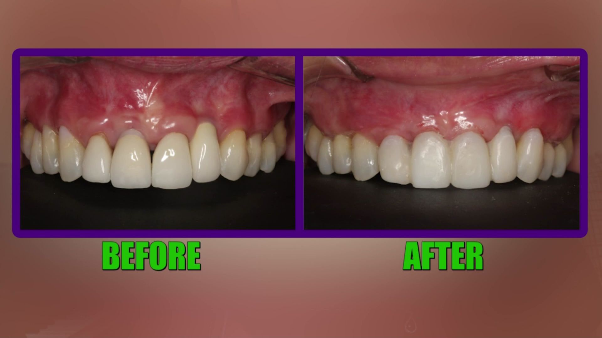 Tooth Root Exposure: Fix Gum Recession Naturally Tooth Root Exposure: Fix Gum Recession Naturally