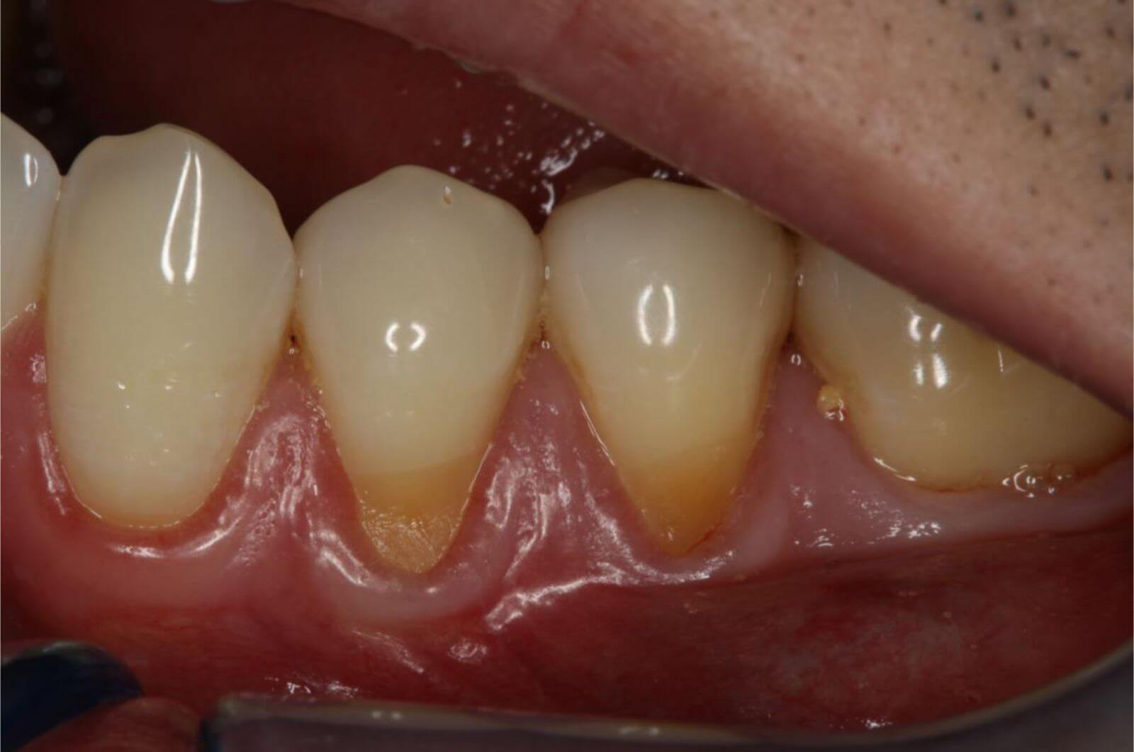 Tooth With Exposed Root: Fix Pain Now