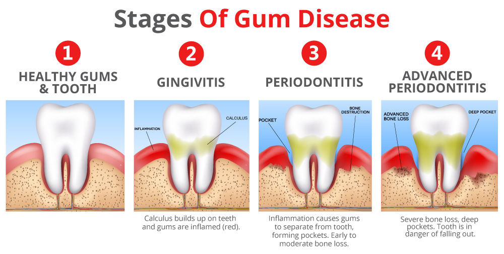 Toothpaste For Gums That Bleed