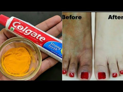 Toothpaste For Sunburn