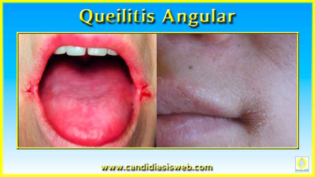 Tratamientos Para Queilitis Angular Explained
