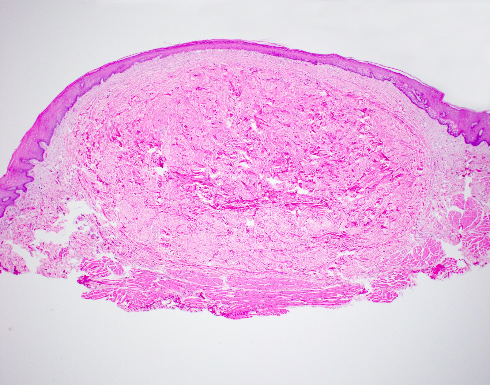 Traumatic Fibroma On Tongue