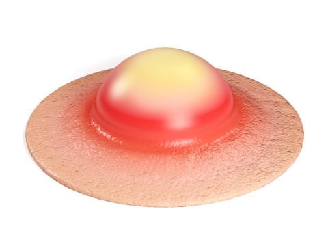 Ulcer Vs Abscess