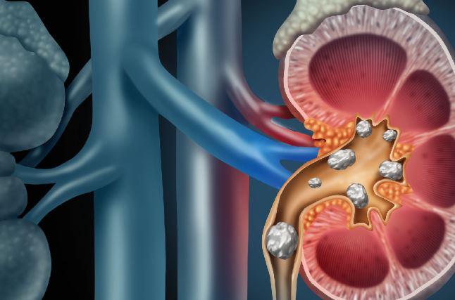 Urinary Stent Pain