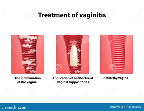 Vagin Bouton Symptoms Explained