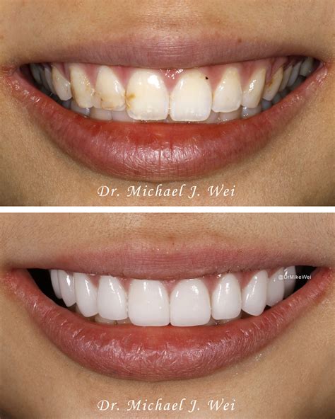 Veneers Cost: Save Up To 70% Today