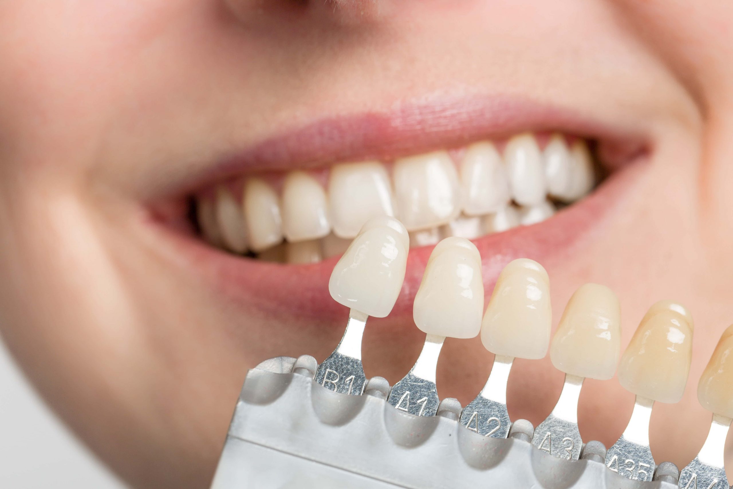 Veneers Price: Get Affordable Smile