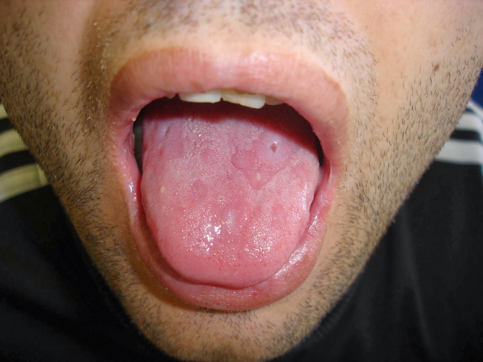 Verrugas Debajo De La Lengua: Síntomas Y Soluciones Naturales