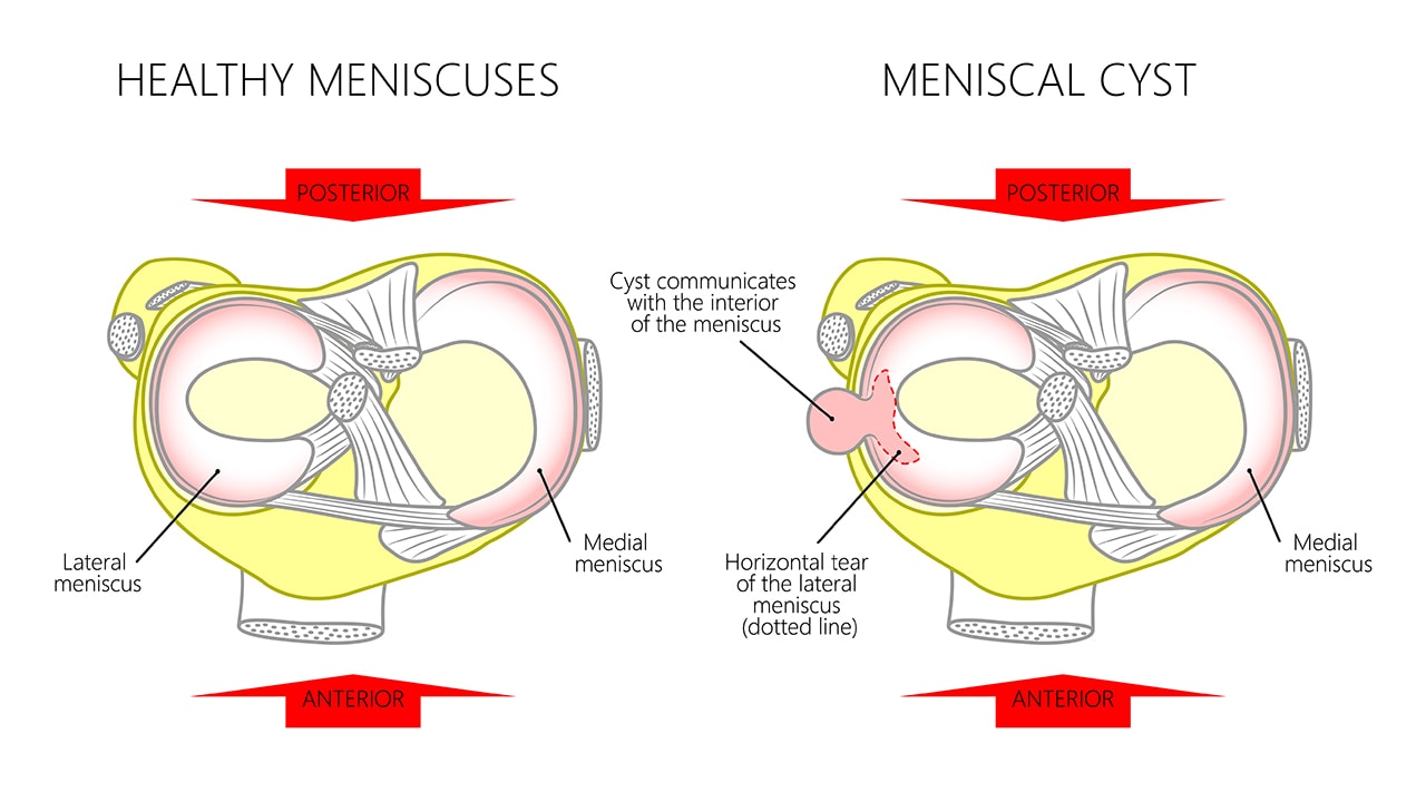 Voluminous Posterior Medial Meniscal Cyst