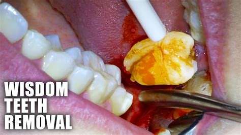 Walk In Wisdom Tooth Removal