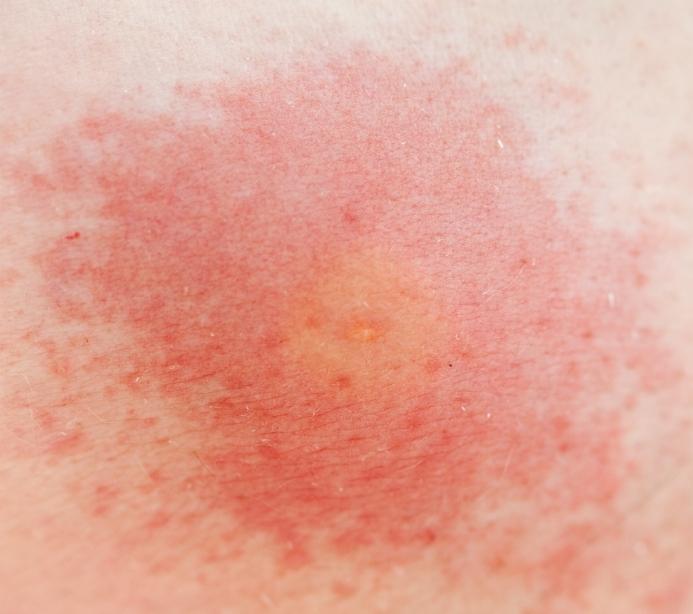 Weeds That Cause Rashes